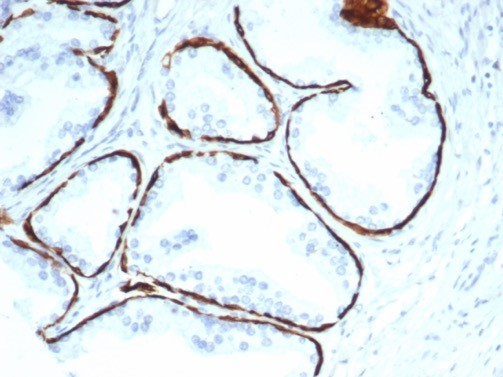 Formalin-fixed, paraffin-embedded human prostate stained with Cytokeratin 14 antibody (KRT14/7054R). HIER: Tris/EDTA, pH9.0, 45min. Secondary: HRP-polymer, 30min. DAB, 5min