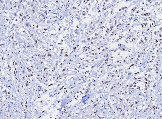 IHC analysis of formalin-fixed, paraffin-embedded human uterus. Strong nuclear staining using TRPS1 antibody (TRPS1/8131R) at 2ug/ml. HIER: Tris/EDTA, pH9.0, 45min. Secondary: HRP-polymer, 30min. DAB, 5min.