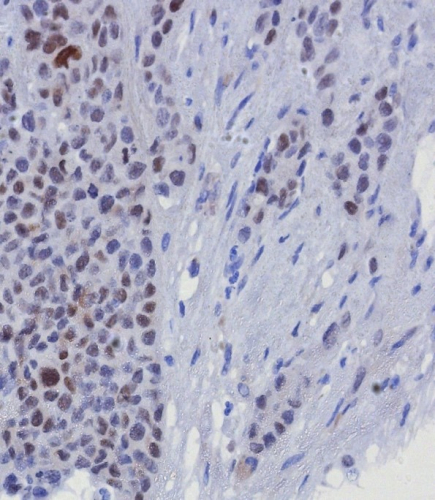 Formalin-fixed, paraffin-embedded human breast carcinoma stained with GATA-3 antibody (GATA3/8327R). HIER: Tris/EDTA, pH9.0, 45min. Secondary: HRP-polymer, 30min. DAB, 5min.