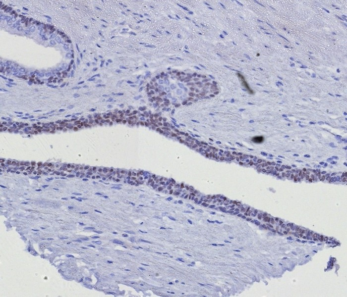 Formalin-fixed, paraffin-embedded human prostate stained with GATA-3 antibody (GATA3/8327R). HIER: Tris/EDTA, pH9.0, 45min. Secondary: HRP-polymer, 30min. DAB, 5min.