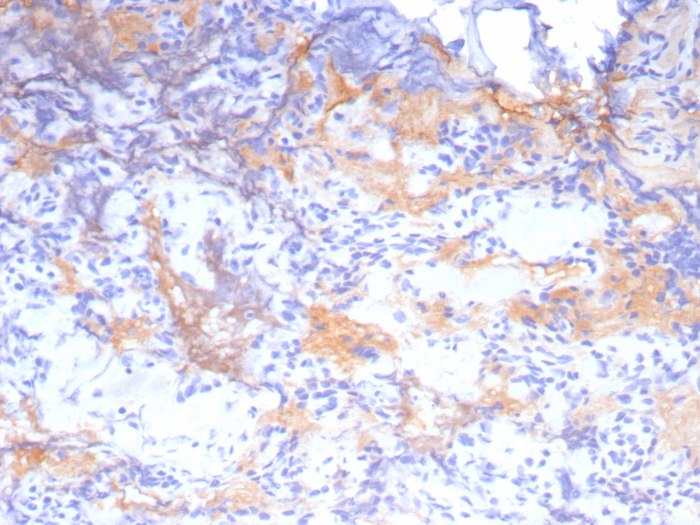 Formalin-fixed, paraffin-embedded human pituitary stained with Growth Hormone antibody (GH/8215R). HIER: Tris/EDTA, pH9.0, 45min. Secondary: HRP-polymer, 30min. DAB, 5min.