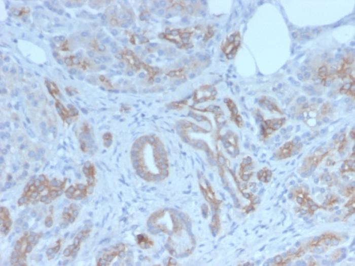 Formalin-fixed, paraffin-embedded human breast carcinoma stained with Golgi Glycoprotein 1/GLG1 antibody (GLG1/7174R).