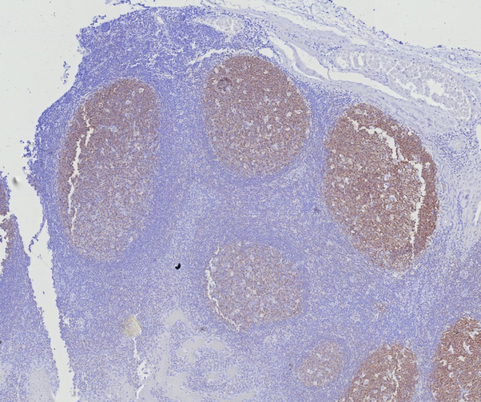 Formalin-fixed, paraffin-embedded human tonsil stained with BOB1 antibody (BOB1/7469). HIER: Tris/EDTA, pH9.0, 45min. Secondary: HRP-polymer, 30min. DAB, 5min.