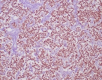 Formalin-fixed, paraffin-embedded human seminoma stained with OCT4 antibody (OCT4/6847R). HIER: Tris/EDTA, pH9.0, 45min. Secondary: HRP-polymer, 30min. DAB, 5min.