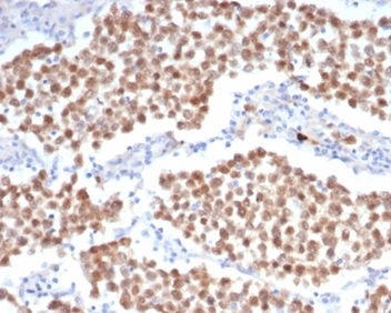 Formalin-fixed, paraffin-embedded human seminoma stained with OCT4 antibody (OCT4/6847R) at 2ug/ml. HIER: Tris/EDTA, pH9.0, 45min. Secondary: HRP-polymer, 30min. DAB, 5min.