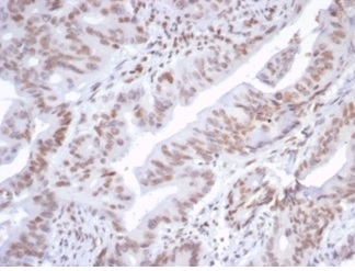 Formalin-fixed, paraffin-embedded human colon stained with ATRX antibody (ATRX/7188R).