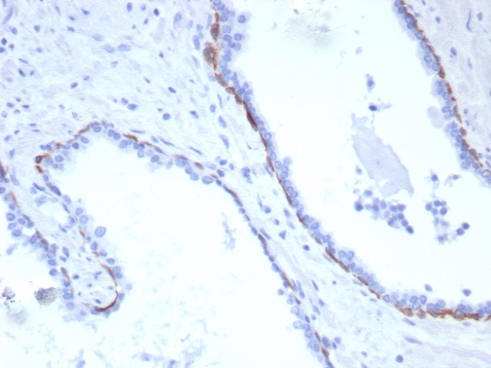Formalin-fixed, paraffin-embedded human prostate carcinoma stained with Cytokeratin 17 antibody (KRT17/8320R). HIER: Tris/EDTA, pH9.0, 45min. Secondary: HRP-polymer, 30min. DAB, 5min.