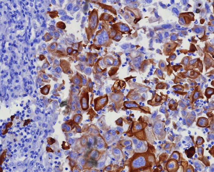 Formalin-fixed, paraffin-embedded human lung adenocarcinoma stained with Cytokeratin 17 antibody (KRT17/8346R). HIER: Tris/EDTA, pH9.0, 45min. 2: HRP-polymer, 30min. DAB, 5min.