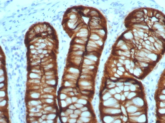 Formalin-fixed, paraffin-embedded human colon adenocarcinoma stained with Villin 1 antibody (VIL1/7378R). HIER: Tris/EDTA, pH9.0, 45min. Secondary: HRP-polymer, 30min. DAB, 5min.