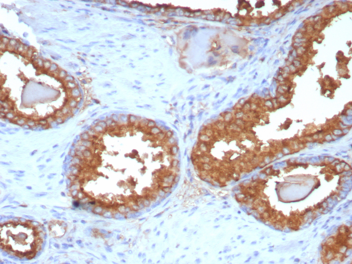Formalin-fixed, paraffin-embedded human prostate carcinoma stained with Prostatic Acid Phosphatase/ACPP antibody (ACPP/8409R). HIER: Tris/EDTA, pH9.0, 45min. Secondary: HRP-polymer, 30min. DAB, 5min.