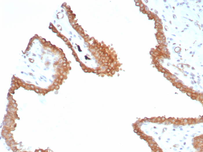 Formalin-fixed, paraffin-embedded human prostate stained with Glutamine Synthetase antibody (GLUL/8517R). HIER: Tris/EDTA, pH9.0, 45min. Secondary: HRP-polymer, 30min. DAB, 5min.