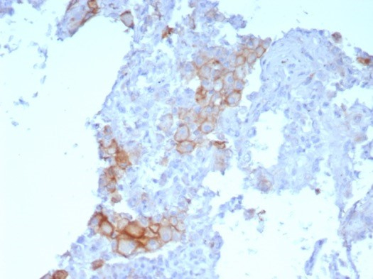 Formalin-fixed, paraffin-embedded human lung SqCC stained with PD-L1 antibody (PDL1/7568R).