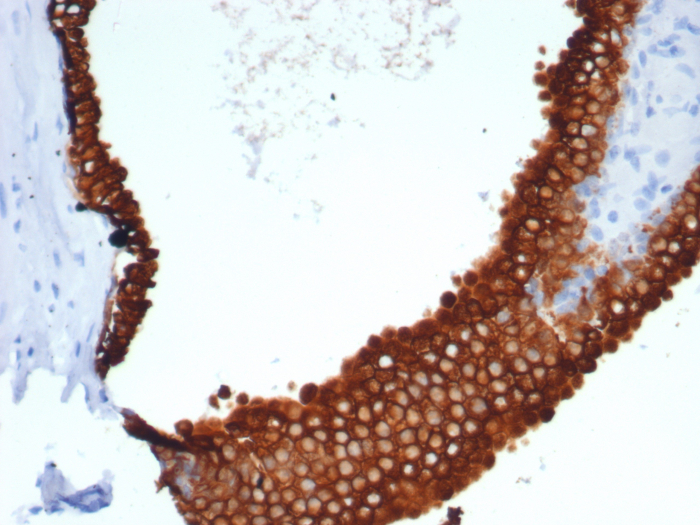 Formalin-fixed, paraffin-embedded human prostate carcinoma stained with Cytokeratin 18 antibody (rKRT18/7299). HIER: Tris/EDTA, pH9.0, 45min. Secondary: HRP-polymer, 30min. DAB, 5min.
