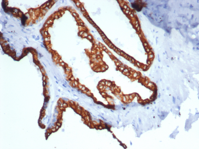 Formalin-fixed, paraffin-embedded human prostate carcinoma stained with Cytokeratin 18 antibody (rKRT18/7299). HIER: Tris/EDTA, pH9.0, 45min. Secondary: HRP-polymer, 30min. DAB, 5min