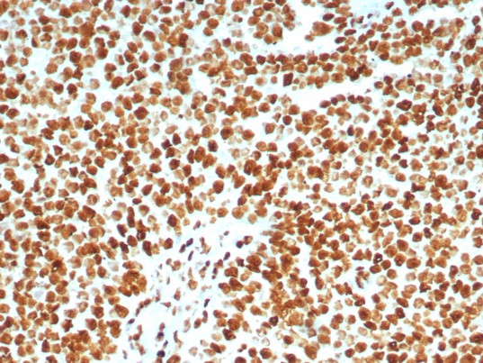 Formalin-fixed, paraffin-embedded human lymph node stained with Ku80/XRCC5 antibody (XRCC5/8093R). HIER: Tris/EDTA, pH9.0, 45min. Secondary: HRP-polymer, 30min. DAB, 5min.