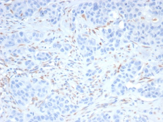 Formalin-fixed, paraffin-embedded human kidney cancer stained with SALL4 antibody (SALL4/7802). HIER: Tris/EDTA, pH9.0, 45min. Secondary: HRP-polymer, 30min. DAB, 5min.