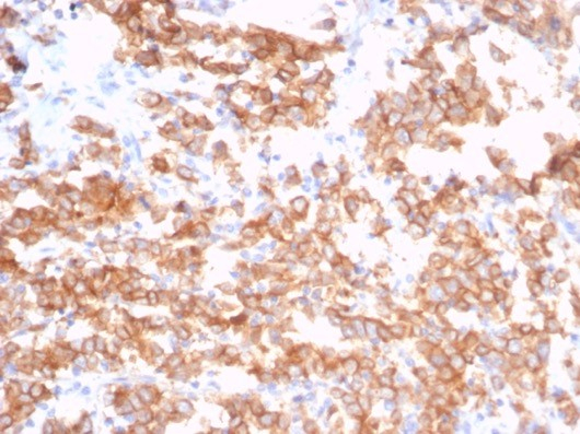 Formalin-fixed, paraffin-embedded human bladder stained with S100 calcium binding protein A14 antibody (S100A14/7402). HIER: Tris/EDTA, pH9.0, 45min. Secondary: HRP-polymer, 30min. DAB, 5min.