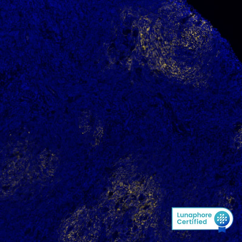CD21 was detected in immersion fixed paraffin-embedded sections of human Hodgkin's Lymphoma using Rabbit Anti-Human CD21, Monoclonal Antibody (Catalog # NBP3-20354) at 1:2000 at 37° Celsius for 4 minutes. Before incubation with the primary antibody, tissue underwent an all-in-one dewaxing and antigen retrieval preprocessing using PreTreatment Module (PT Module) and Dewax and HIER Buffer H (pH 9; Epredia Catalog #TA-999-DHBH).Tissue was stained using the Alexa Fluor™ Plus 555 Goat anti-Rabbit IgG Secondary Antibody at 1:100 at 37 ° Celsius for 2 minutes. (Yellow; Lunaphore Catalog # DR555RB) and counterstained with DAPI (blue; Lunaphore Catalog # DR100). Specific staining was localized to the membrane. Protocol available in COMET™ Panel Builder. 