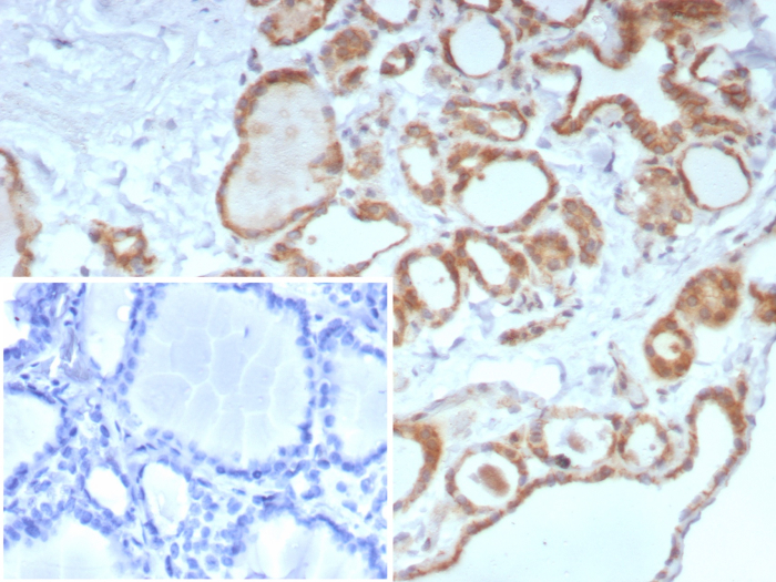 Formalin-fixed, paraffin-embedded human thyroid stained with Calcitonin antibody (CALCA/8639R). Inset: PBS instead of primary antibody; secondary only negative control.