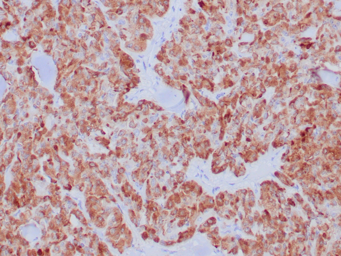 Formalin-fixed, paraffin-embedded human medullary carcinoma stained with Calcitonin antibody (CALCA/8639R). HIER: Tris/EDTA, pH9.0, 45min. Secondary: HRP-polymer, 30min. DAB, 5min.