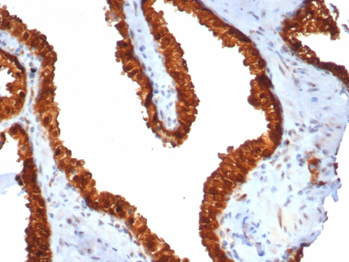 Formalin-fixed, paraffin-embedded human prostate carcinoma stained with TROP-2 antibody (TACSTD2/7348R). HIER: Tris/EDTA, pH9.0, 45min. Secondary: HRP-polymer, 30min. DAB, 5min.