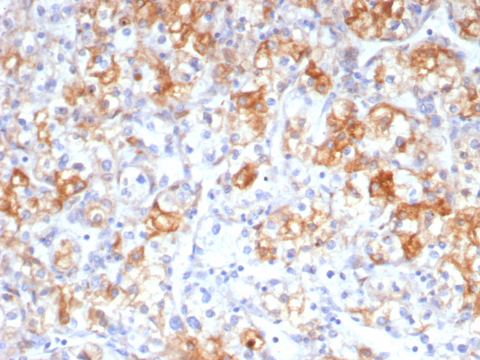 Formalin-fixed, paraffin-embedded human renal cell carcinoma stained with COX-2 antibody (rCOX2/6996). HIER: Tris/EDTA, pH9.0, 45min. Secondary: HRP-polymer, 30min. DAB, 5min.