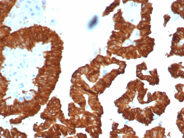 Formalin-fixed, paraffin-embedded human kidney cancer stained with AlphaB Crystallin/CRYAB antibody (CRYAB/4661). HIER: Tris/EDTA, pH9.0, 45min. Secondary: HRP-polymer, 30min. DAB, 5min.