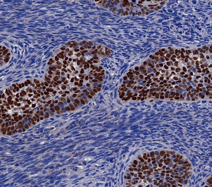 Formalin-fixed, paraffin-embedded human lung carcinoma stained with p40/deltaNp63 antibody (P40/8225R). HIER: Tris/EDTA, pH9.0, 45min. 2: HRP-polymer, 30min. DAB, 5min.