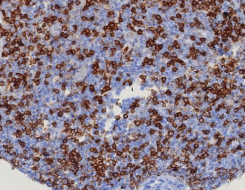 Formalin-fixed, paraffin-embedded human tonsil stained with CD45RA antibody (PTPRC/8124R). HIER: Tris/EDTA, pH9.0, 45min. Secondary: HRP-polymer, 30min. DAB, 5min.