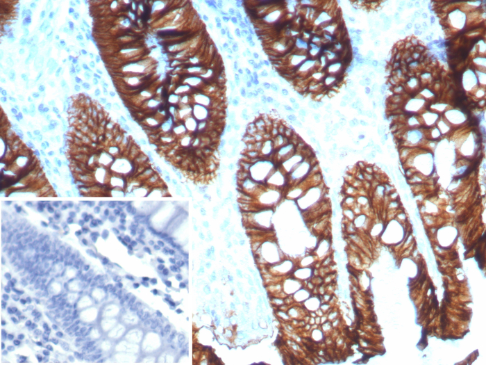 Formalin-fixed, paraffin-embedded human colon stained with Cadherin-17 antibody (CDH17/8515R). Inset: PBS instead of primary antibody; secondary only negative control.