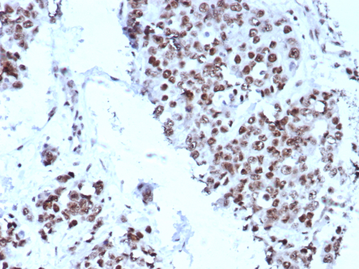 IHC analysis of formalin-fixed, paraffin-embedded human bladder. Strong nuclear staining using p57 Kip2 antibody (KIP2/8572) at 2ug/ml in PBS for 30min RT.
