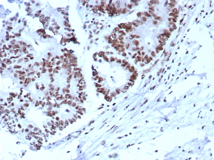 IHC analysis of formalin-fixed, paraffin-embedded human colon. Strong nuclear staining using p57 Kip2 antibody (KIP2/8572) at 2ug/ml in PBS for 30min RT.