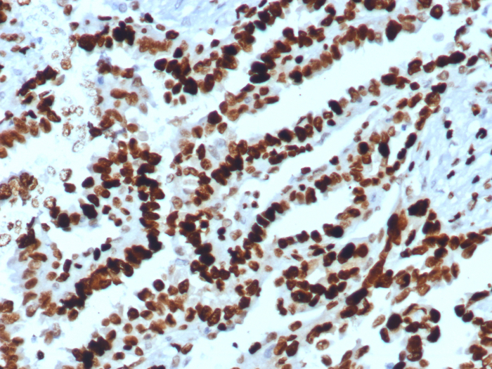 Formalin-fixed, paraffin-embedded human ovarian carcinoma stained with MCM2 antibody (MCM2/8006R). Inset: PBS instead of primary antibody, secondary only control.