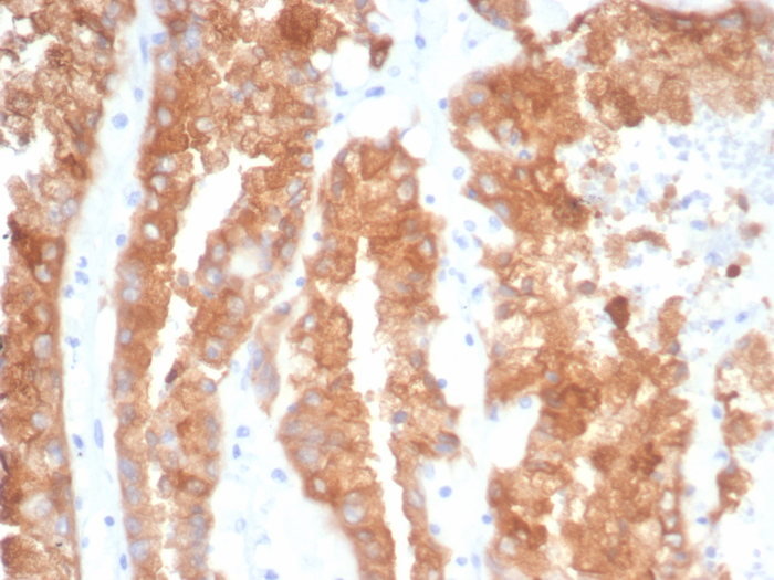 Formalin-fixed, paraffin-embedded human prostate cancer stained with AlphaB Crystallin/CRYAB antibody (CRYAB/4663). HIER: Tris/EDTA, pH9.0, 45min. Secondary: HRP-polymer, 30min. DAB, 5min.