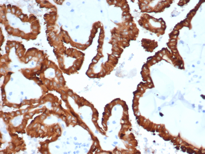 Formalin-fixed, paraffin-embedded human kidney cancer stained with AlphaB Crystallin/CRYAB antibody (CRYAB/4665). HIER: Tris/EDTA, pH9.0, 45min. Secondary: HRP-polymer, 30min. DAB, 5min.