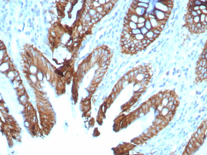 Formalin-fixed, paraffin-embedded human colon stained with Cadherin-17 antibody (rCDH17/8512). HIER: Tris/EDTA, pH9.0, 45min. Secondary: HRP-polymer, 30min. DAB, 5min.