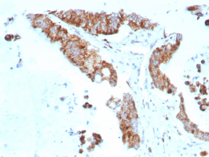 Formalin-fixed, paraffin-embedded human colon carcinoma stained with BCMA/TNFRSF17 antibody (rCD269/8507). HIER: Tris/EDTA, pH9.0, 45min. Secondary: HRP-polymer, 30min. DAB, 5min.