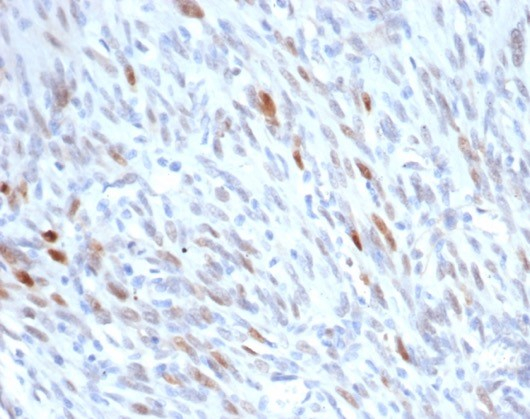 Formalin-fixed, paraffin-embedded human liposarcoma stained with MDM2/HDM2 antibody (MDM2/7190R). HIER: Tris/EDTA, pH9.0, 45min. Secondary: HRP-polymer, 30min. DAB, 5min.