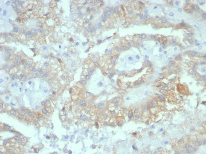 Formalin-fixed, paraffin-embedded human renal cell carcinoma stained with AlphaB Crystallin/CRYAB antibody (CRYAB/7918). HIER: Tris/EDTA, pH9.0, 45min. Secondary: HRP-polymer, 30min. DAB, 5min.