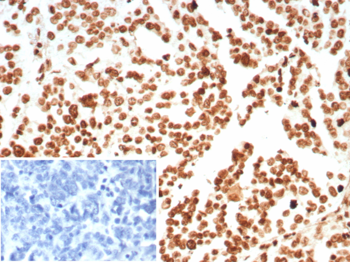 Formalin-fixed, paraffin-embedded human ovarian carcinoma stained with H1F0 antibody (rHH1/8702). Inset: PBS instead of primary antibody; secondary only negative control.