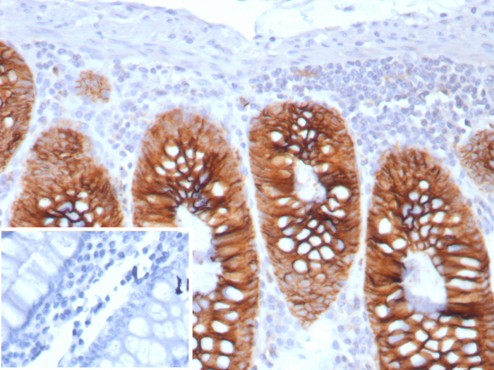 Formalin-fixed, paraffin-embedded human colon stained with Cadherin-17 antibody (CDH17/8513R). Inset: PBS instead of primary antibody; secondary only negative control.