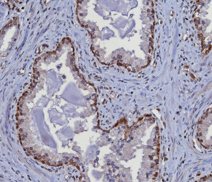 Formalin-fixed, paraffin-embedded human prostate stained with MGMT antibody (MGMT/8364R). HIER: Tris/EDTA, pH9.0, 45min. Secondary: HRP-polymer, 30min. DAB, 5min.