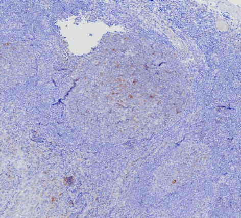 Formalin-fixed, paraffin-embedded human tonsil stained with BCMA/TNFRSF17 antibody (CD269/7986R). HIER: Tris/EDTA, pH9.0, 45min. Secondary: HRP-polymer, 30min. DAB, 5min.