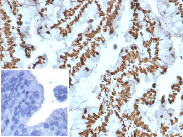 Formalin-fixed, paraffin-embedded human prostate carcinoma stained with ZNF846 antibody (PCRP-ZNF846-1E12). Inset: PBS instead of primary antibody; secondary only negative control.