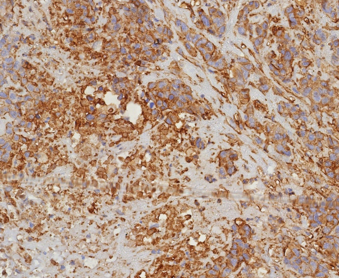 Formalin-fixed, paraffin-embedded human bladder carcinoma stained with HLA G antibody (HLAG/8344R). HIER: Tris/EDTA, pH9.0, 45min. 2: HRP-polymer, 30min. DAB, 5min.