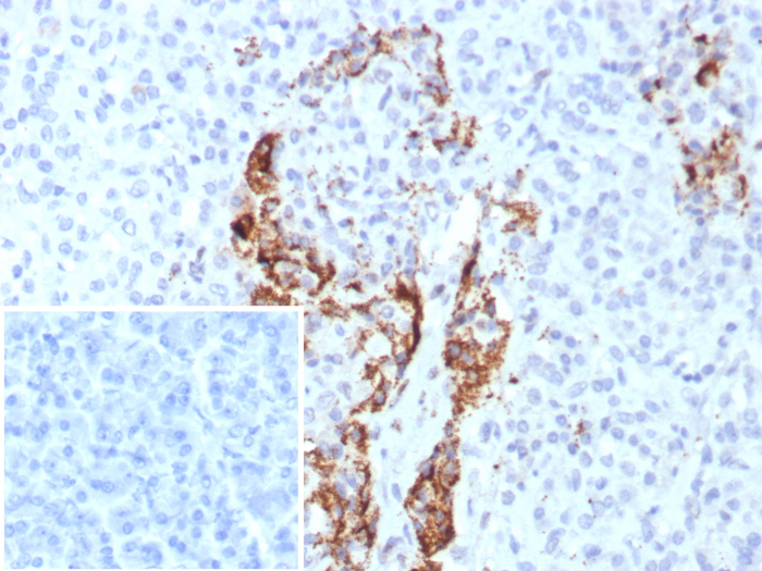Formalin-fixed, paraffin-embedded human pancreas stained with Insulin antibody (rIRDN/8546). Inset: PBS instead of primary antibody; secondary only negative control.