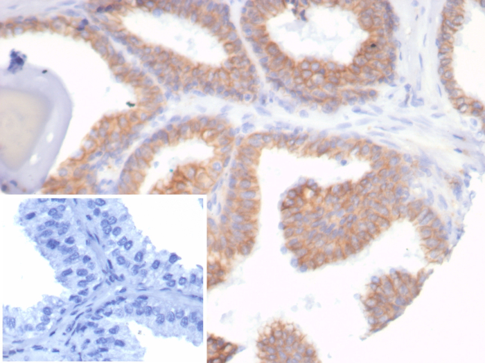 Formalin-fixed, paraffin-embedded human prostate carcinoma stained with E-Cadherin antibody (rCDH1/7352). Inset: PBS instead of primary antibody; secondary only negative control.