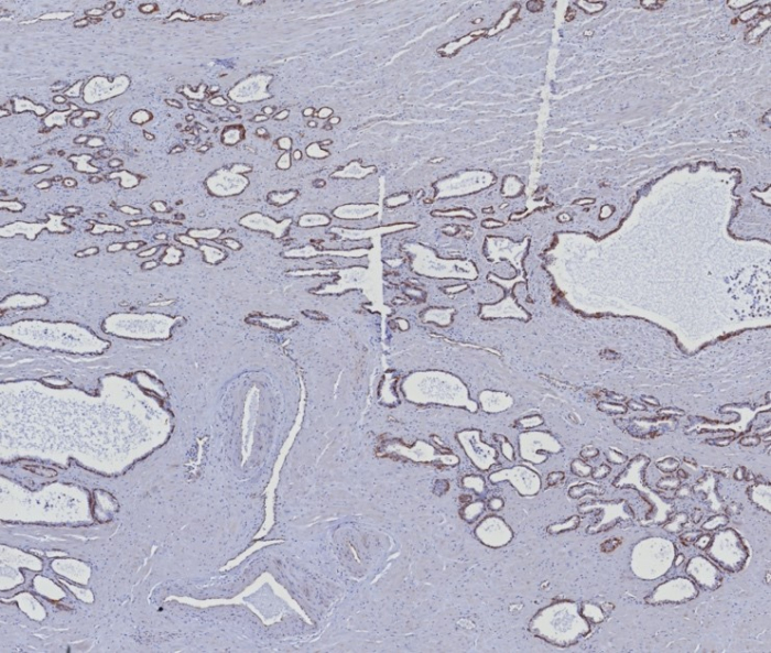 Formalin-fixed, paraffin-embedded human prostate carcinoma stained withCytokeratin 5/6 antibody (KRT5.6/8275R). HIER: Tris/EDTA, pH9.0, 45min. Secondary: HRP-polymer, 30min. DAB, 5min.