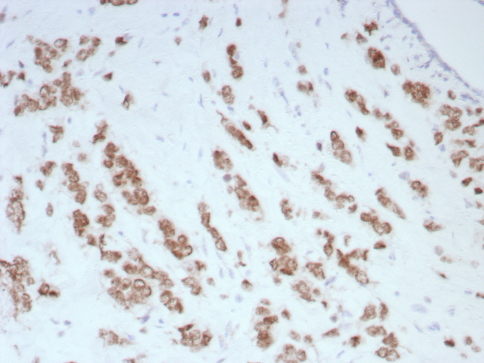 Formalin-fixed, paraffin-embedded human breast carcinoma stained with Androgen R/NR3C4 antibody (DHTR/8698R). HIER: Tris/EDTA, pH9.0, 95C/45min. SecondaryAb: HRP-Poly:30min. DAB:5min.
