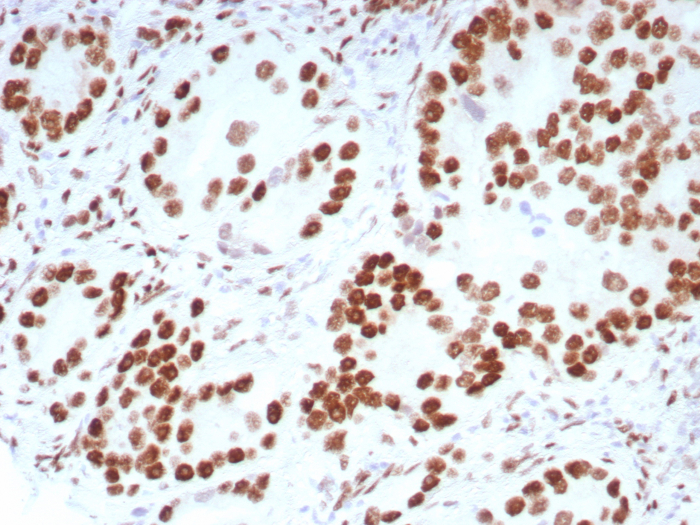 Formalin-fixed, paraffin-embedded human prostate carcinoma stained with Androgen R/NR3C4 antibody (DHTR/8698R). HIER: Tris/EDTA, pH9.0, 95C/45min. SecondaryAb: HRP-Poly:30min. DAB:5min.